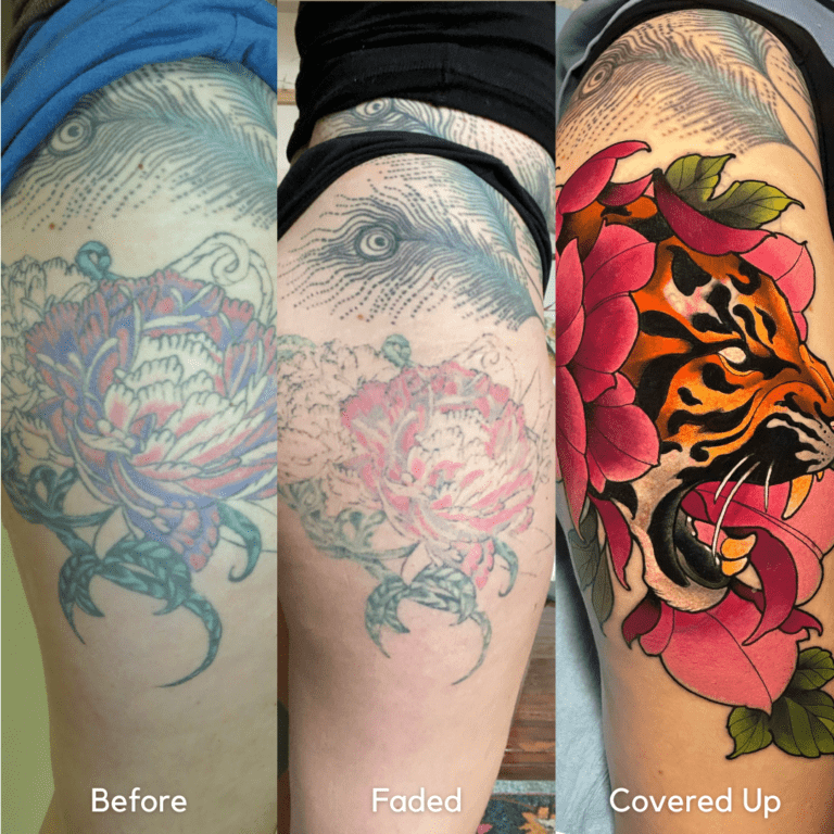Tattoo cover-up, Laser removal